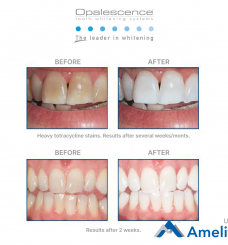 Відбілююча система Opalescence 16%PF (Ultradent), шприц 1.2 мл